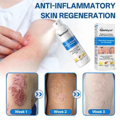 💥Official shop✅: Sparklyra® Herbal magnesium spray for psoriasis