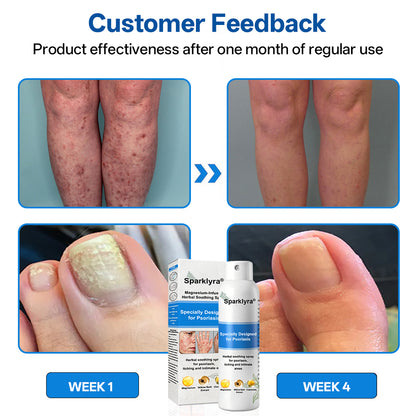 💥Official shop✅: Sparklyra® Herbal magnesium spray for psoriasis